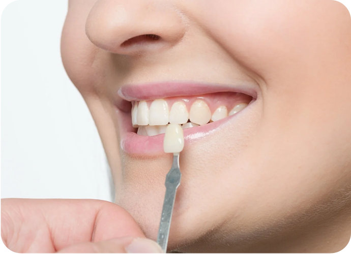 Cosmetic Bonding