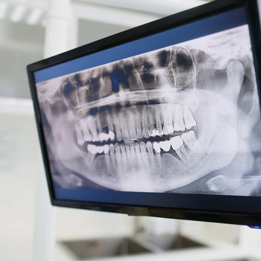 Digital Dental Implants