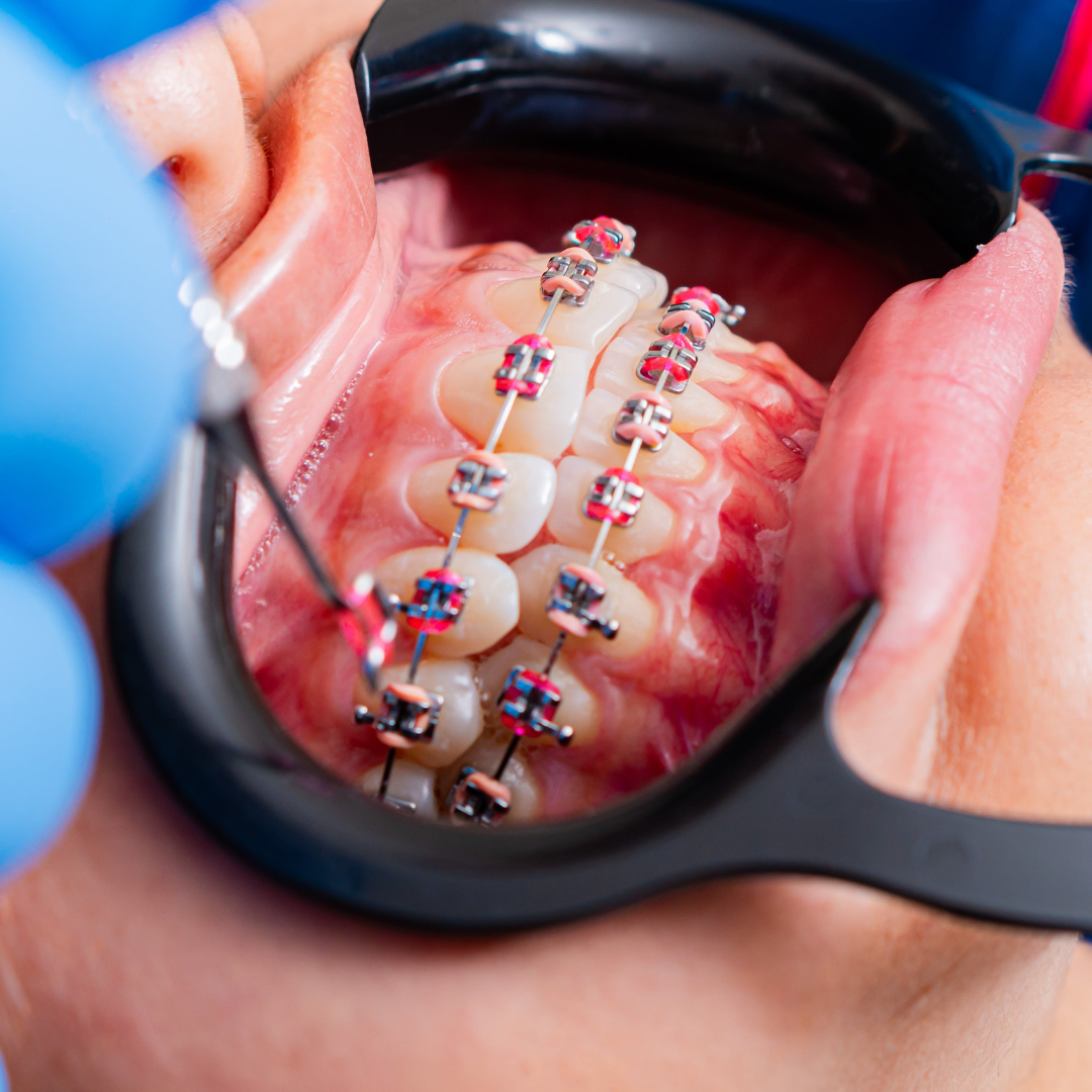 Orthodontic Braces