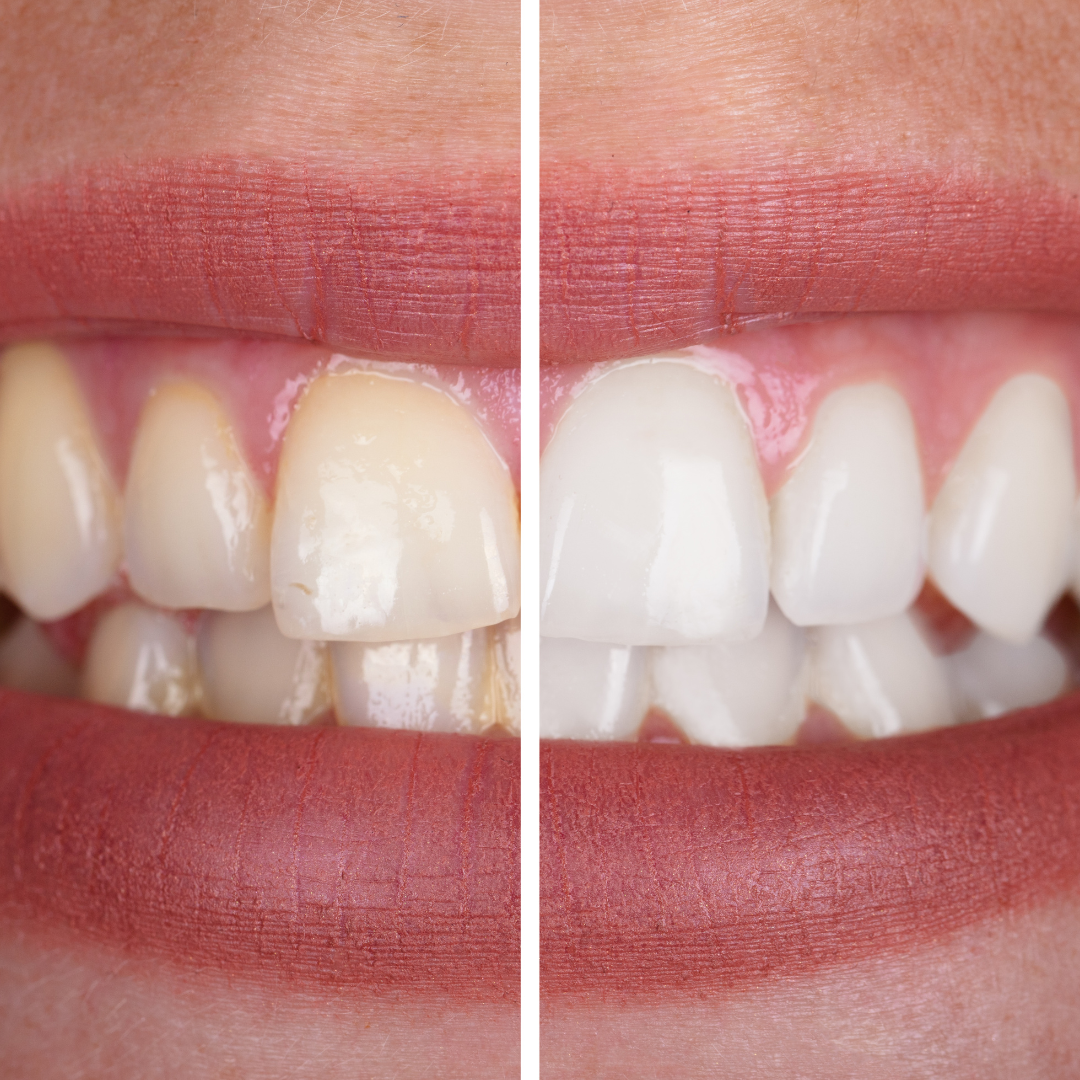 Teeth Whitening & Cleaning