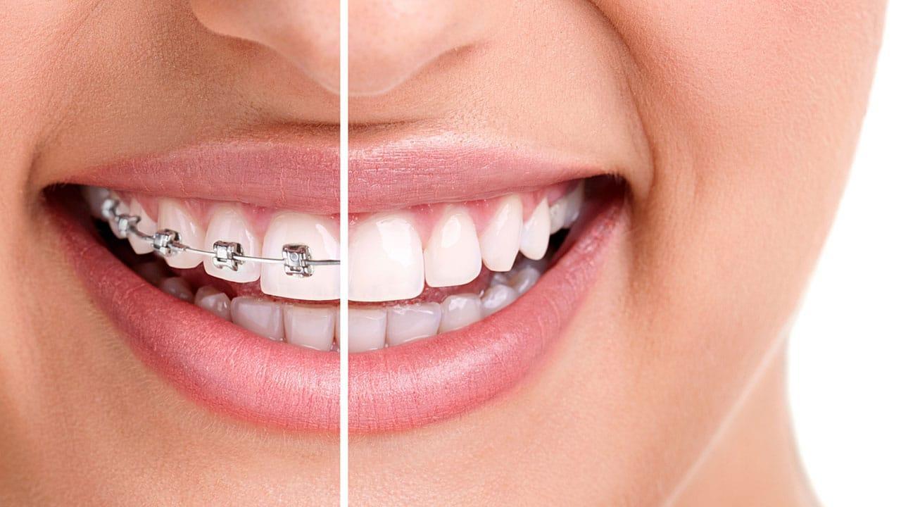 Orthodontic Braces